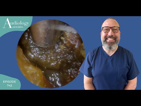 VERY FULL EAR WAX & SKIN REMOVAL - EP742