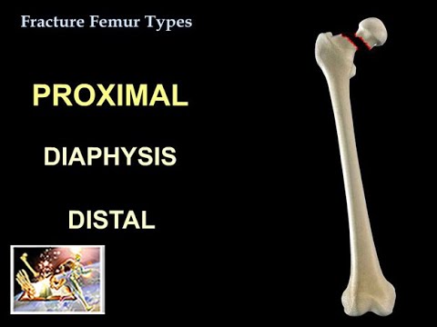Fracture Femur Types  - Everything You Need To Know - Dr. Nabil Ebraheim
