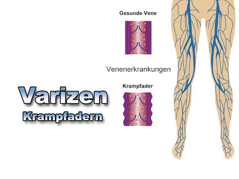 Varizen | Krankheiten der Blutgefäße | Pflege Kanal