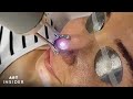 5 Laser Treatments To Instantly Transform Your Skin | Insider Art