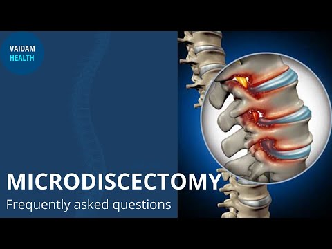 Microdiscectomy - Frequently Asked Questions