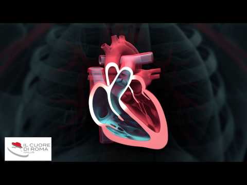 LA FIBRILLAZIONE ATRIALE (SHORT)