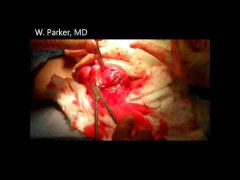 Abdominal Myomectomy - Removal of 18 Fibroids From a 49 Year Old Patient