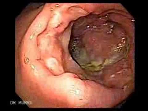 Cancer in peritoneal lining