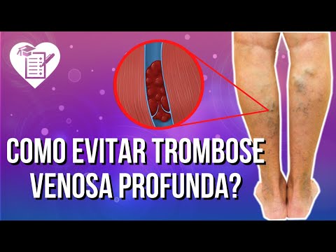 TROMBOSE VENOSA PROFUNDA - Causas, Sintomas e Tratamento