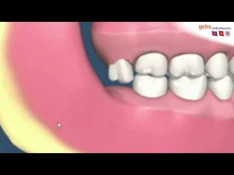 Verwijdering verstandskies: waarom?