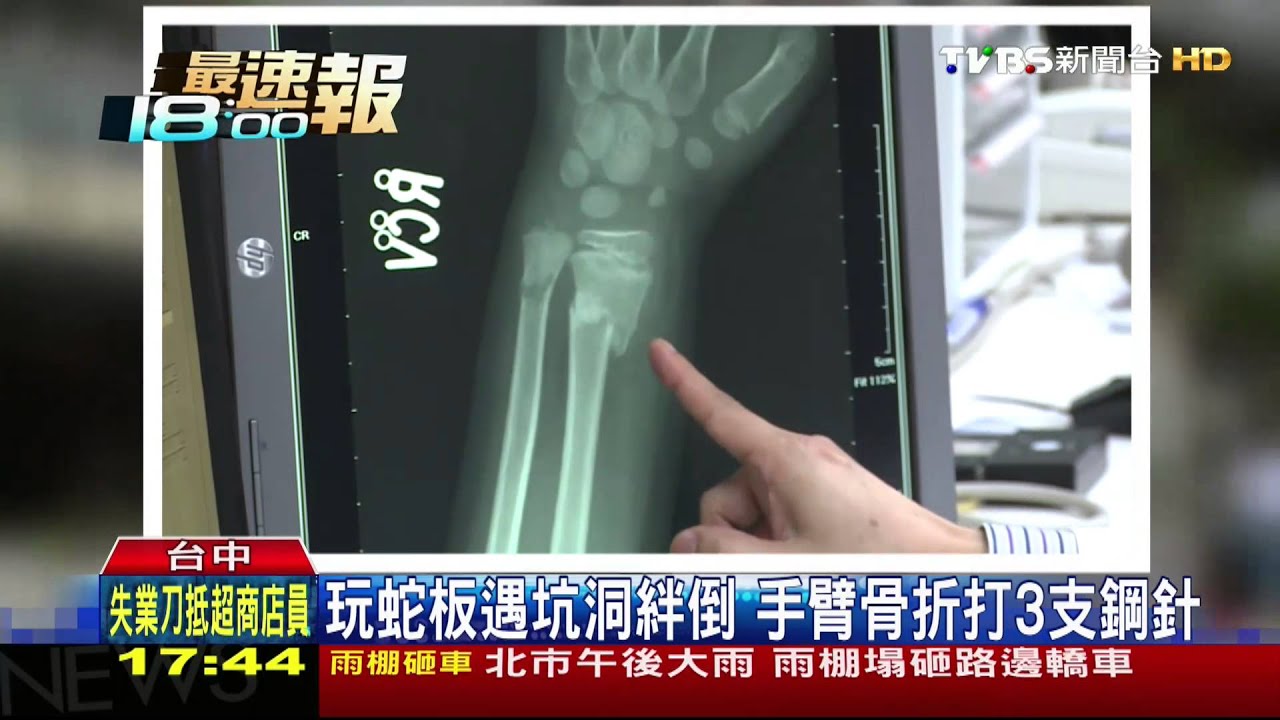 蛇板危險!跌倒骨折1月5起 嚴重打鋼針