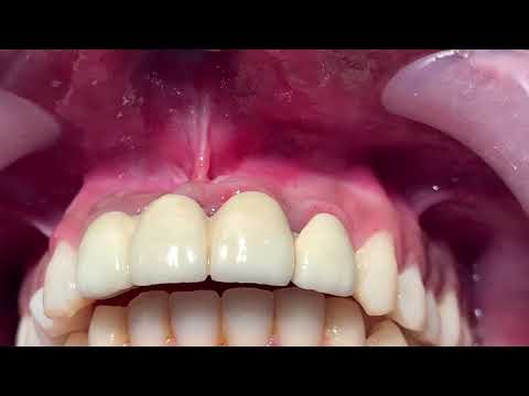 Periapical Cyst Removal And Apicoectomy Surgery For Radicular Cyst