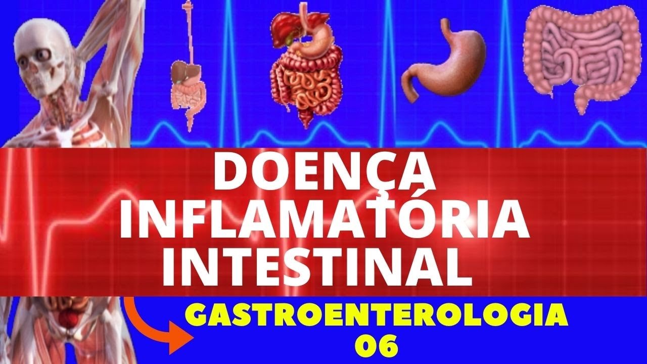 DOENÇA INFLAMATÓRIA INTESTINAL (DOENÇA DE CROHN E RETOCOLITE ULCERATIVA) - GASTROENTEROLOGIA