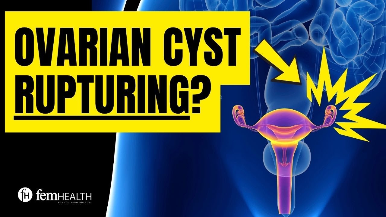What does an ovarian cyst feel like when it ruptures? What to do for rupturing ovarian cyst?