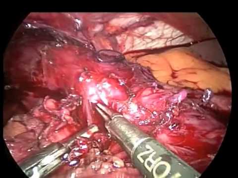 Laparoscopic Repair Of Hiatal Hernia, Diverticulectomy And Completion Esophagomyotomy For Incomplete Transthoracic Esophagomyotomy.