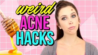 How to Get Rid of Acne FAST - WEIRD ACNE LIFE HACKS | Courtney Lundquist