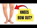 How To Walk With Less Pain When Bow-Legged
