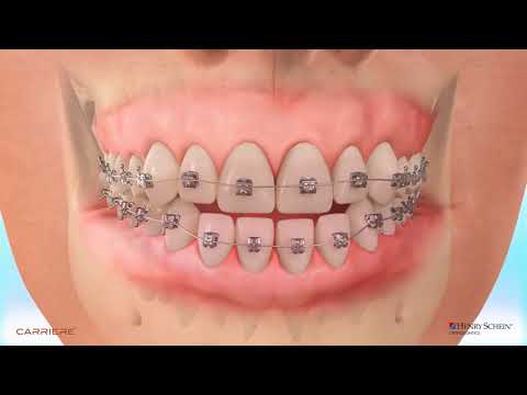 Carriere® Motion™ Appliance for Class III Correction   Patient Education Animation 1