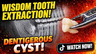 Horizontal Wisdom Tooth With Cyst- Removal Video from Surgeons View!