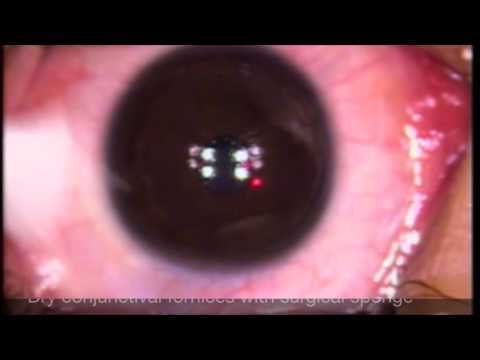 Vitrocap kapszula a látáshoz