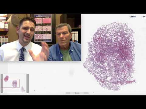 Pattern 1 - Acute Lung Injury, Vaping Associated Lung Injury (Top 25 Pearls Series, Topic 1 Pearl 2)