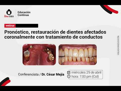 Webinar - Pronóstico, restauración de dientes afectados coronalmente con tratamiento de conductos