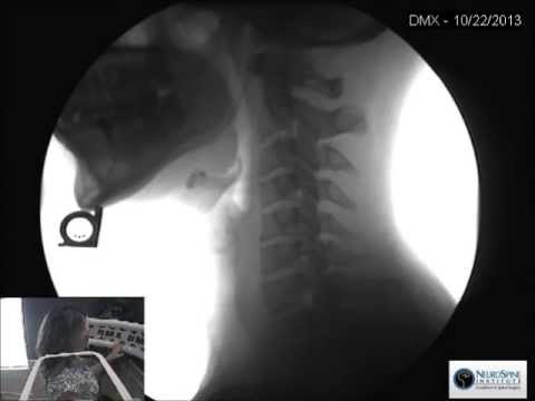 Digital Motion X-Ray (DMX) New at the NeuroSpine Institute (Live X-Ray)