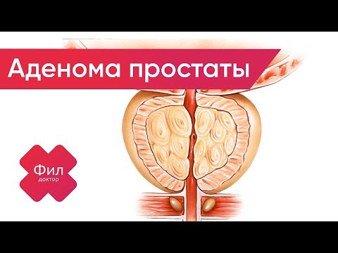 Как вылечить аденому простаты без операции