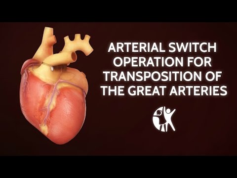 Arterial Switch Operation for Transposition of the Great Arteries | Cincinnati Children's