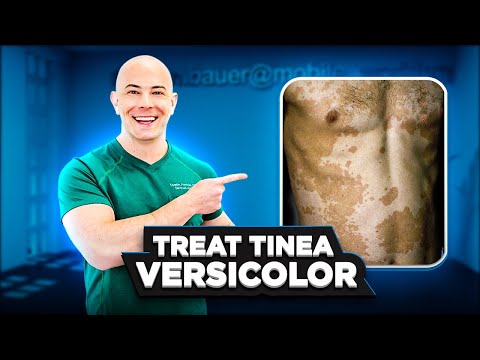 How to Treat Tinea Versicolor and Keep it From Coming Back - 🛑 SEE MY PINNNED COMMENT FOR UPDATE👇