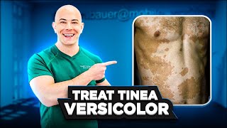 How to Treat Tinea Versicolor and Keep it From Coming Back - 🛑 SEE MY PINNNED COMMENT FOR UPDATE👇