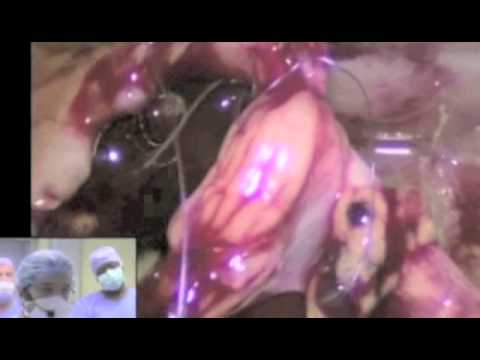 Retroperitoneal Laparoscopic Pyeloplasty In Children