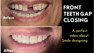 Front teeth gaping treatment with Zirconia Crowns | solution for space between front teeth.