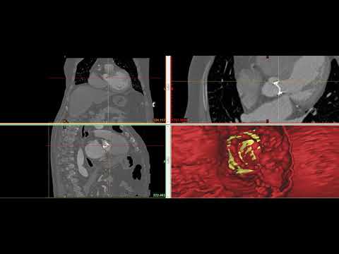 Case #42 : Paravalvular leak
