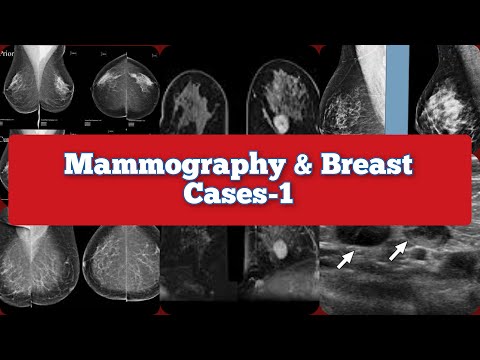 Radiology Viva Cases | Mammography and Breast Cases Part-1 #medical #radiology #ultrasound