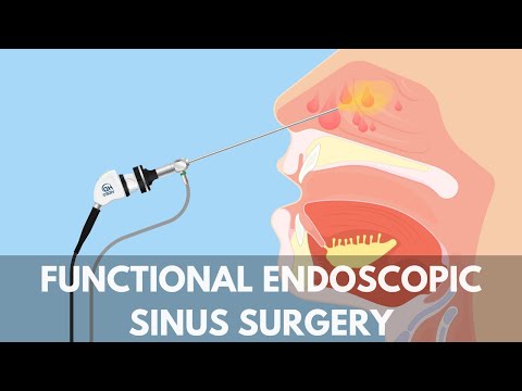 Functional Endoscopic Sinus Surgery Capital ENT