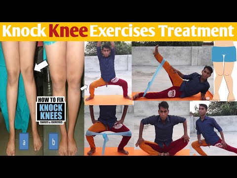 knock knees correction exercises // knock knee ko kaise thik kare, genu valgum traitement, in hindi