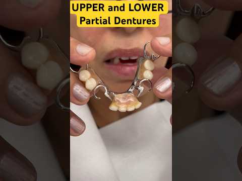 UPPER and LOWER Partial Dentures #youtubeshorts #shorts#viral