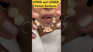 Download lagu UPPER and LOWER Partial Dentures #youtubeshorts #shorts#viral mp3