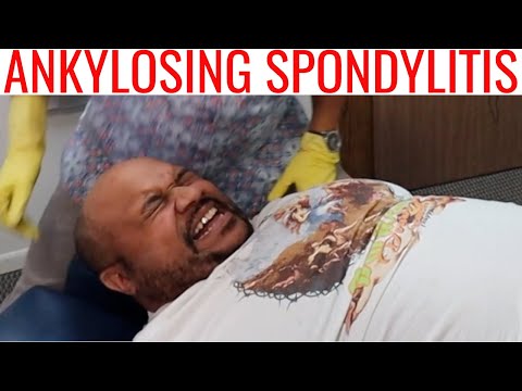 Ankylosing Spondylitis & Gout patient gets treated by CHIROPRACTOR 2/2