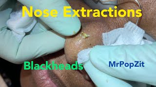 Nose extractions. Blackheads. Whiteheads . DPOW. Pore dirt cleared. Pop talk. Fun patient. MrPopZit
