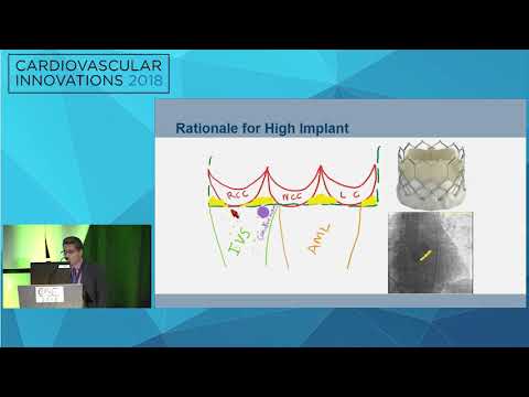 CVI2018 Session: Innovation in Aortic Valve Therapy (Colorado Ballroom, Thursday, July 26, 08:30 am)