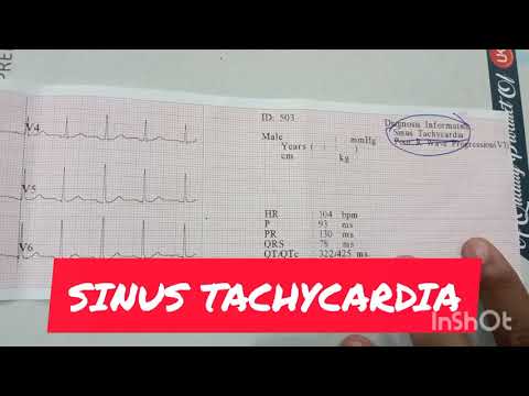 Sinus Tachycardia I #ECG रिपोर्ट कैसे देखते हैं।