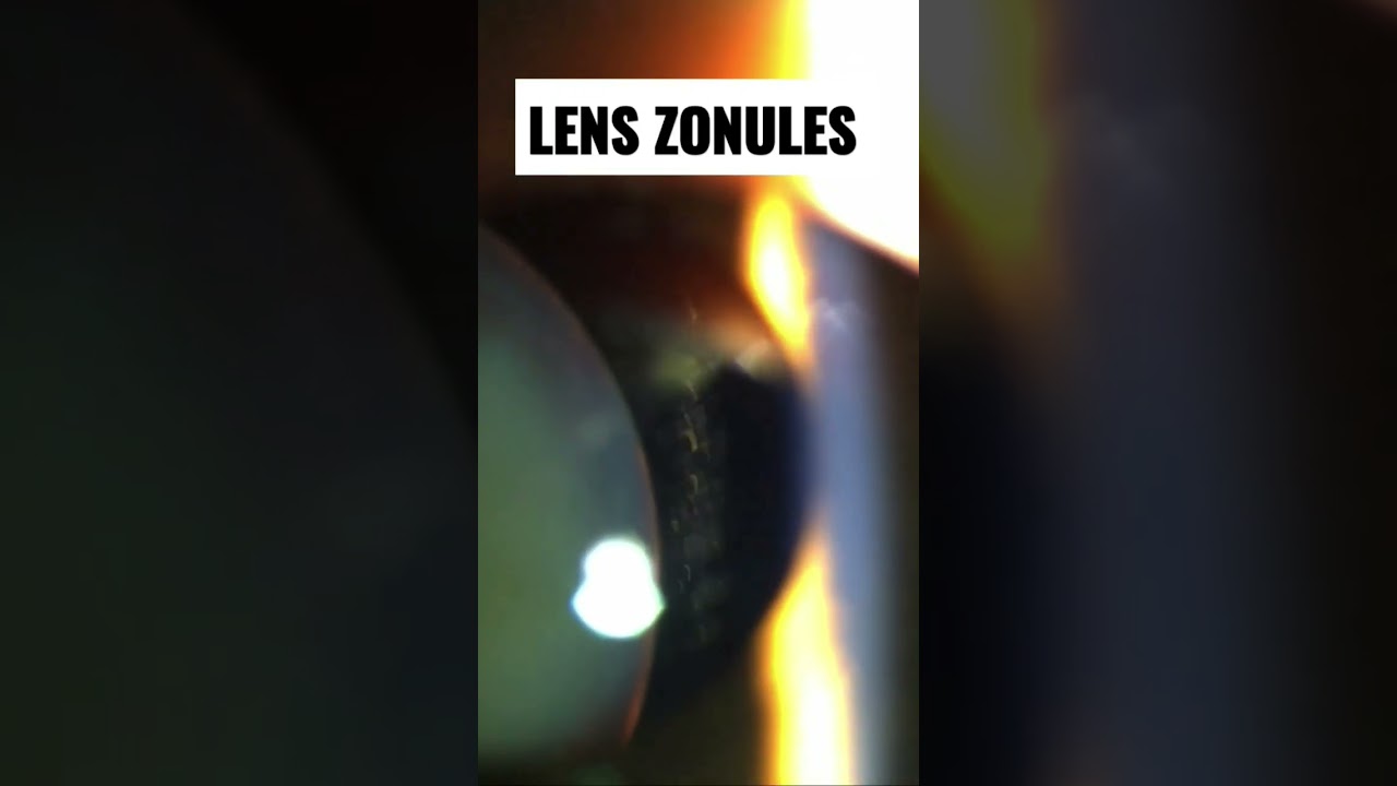 Lens Zonules