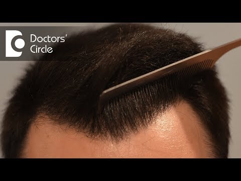 How many hair transplant grafts do you need to cover bald areas? - Dr. Deepak P Devakar