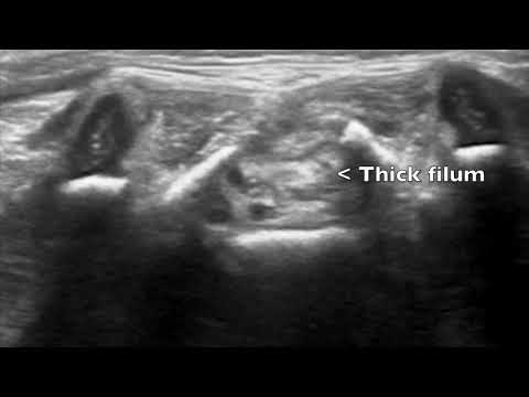 Spinal US - thick filum