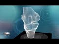 ConforMIS Knee Replacement Segment with Dr. Palumbo