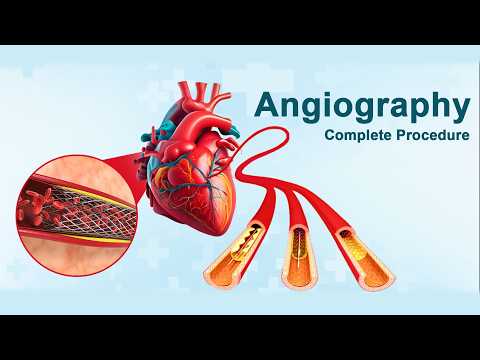 Angiography (Heart) Procedure (3D Animation)