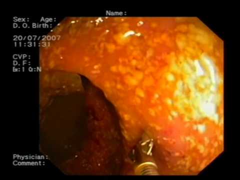 Jóindulatú papilloma tumor