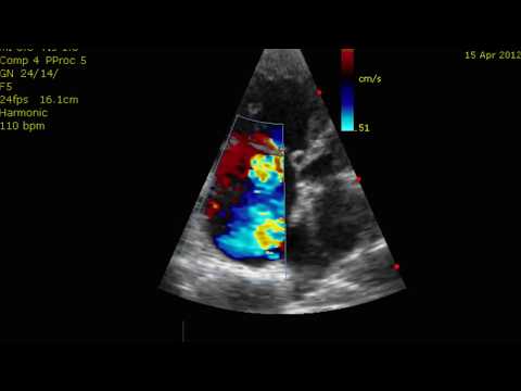 Proteine, die für Patienten mit Hypertonie Pulmonale Hypertonie ist höher mm Hg
