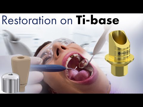 Do you need to use a Ti base? The different types of dental parts & digital impression