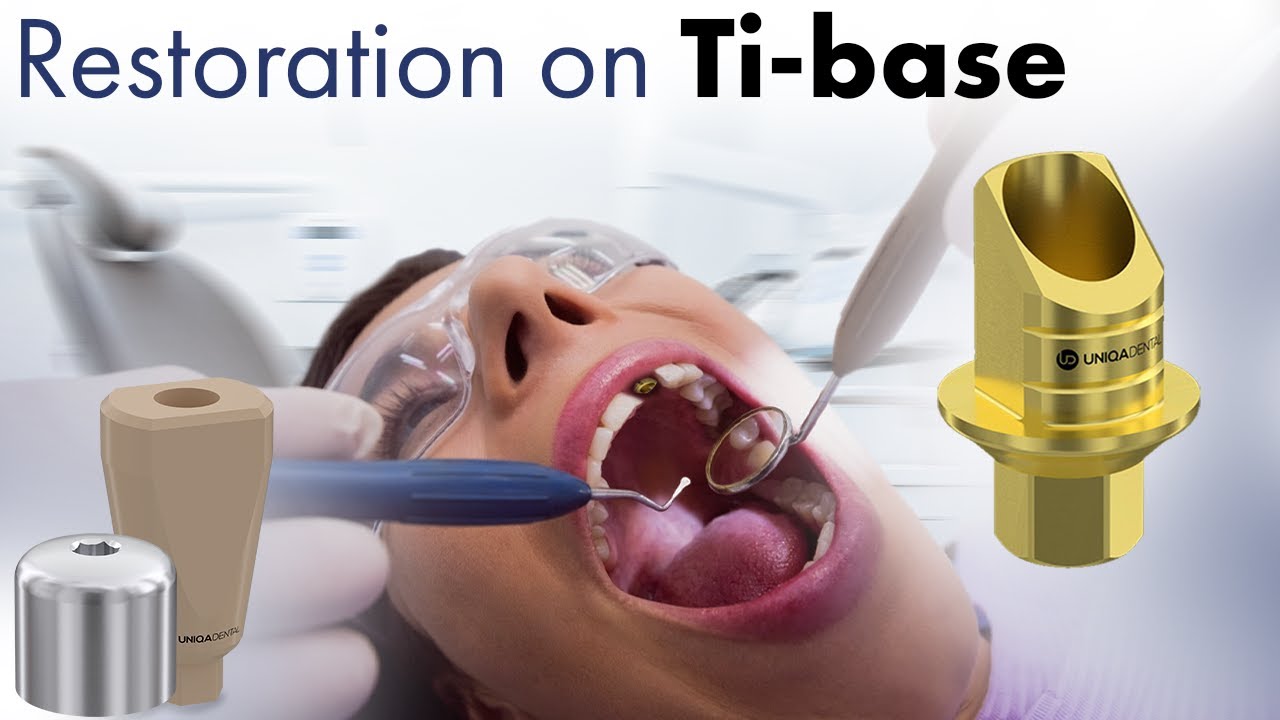 Do you need to use a Ti base? The different types of dental parts & digital impression