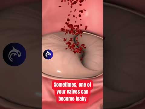 Do you have a leaky Heart Valve? See how it's fixed.🫀 #heartbeat #anatomy #medicalanimation