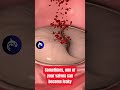 Do You Have A Leaky Heart Valve See How It S Fixed Heartbeat Anatomy Medicalanimation